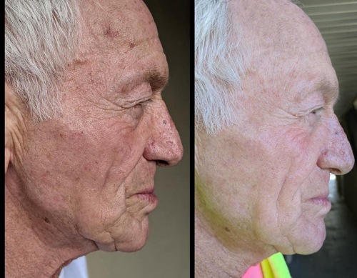 71_year_old-10-day_results-Michele